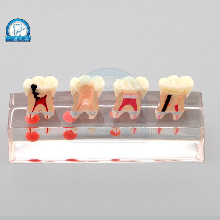 口腔医学教学教具 牙髓修复模型 展示龋 齿蛀牙病理修复 髓腔 根